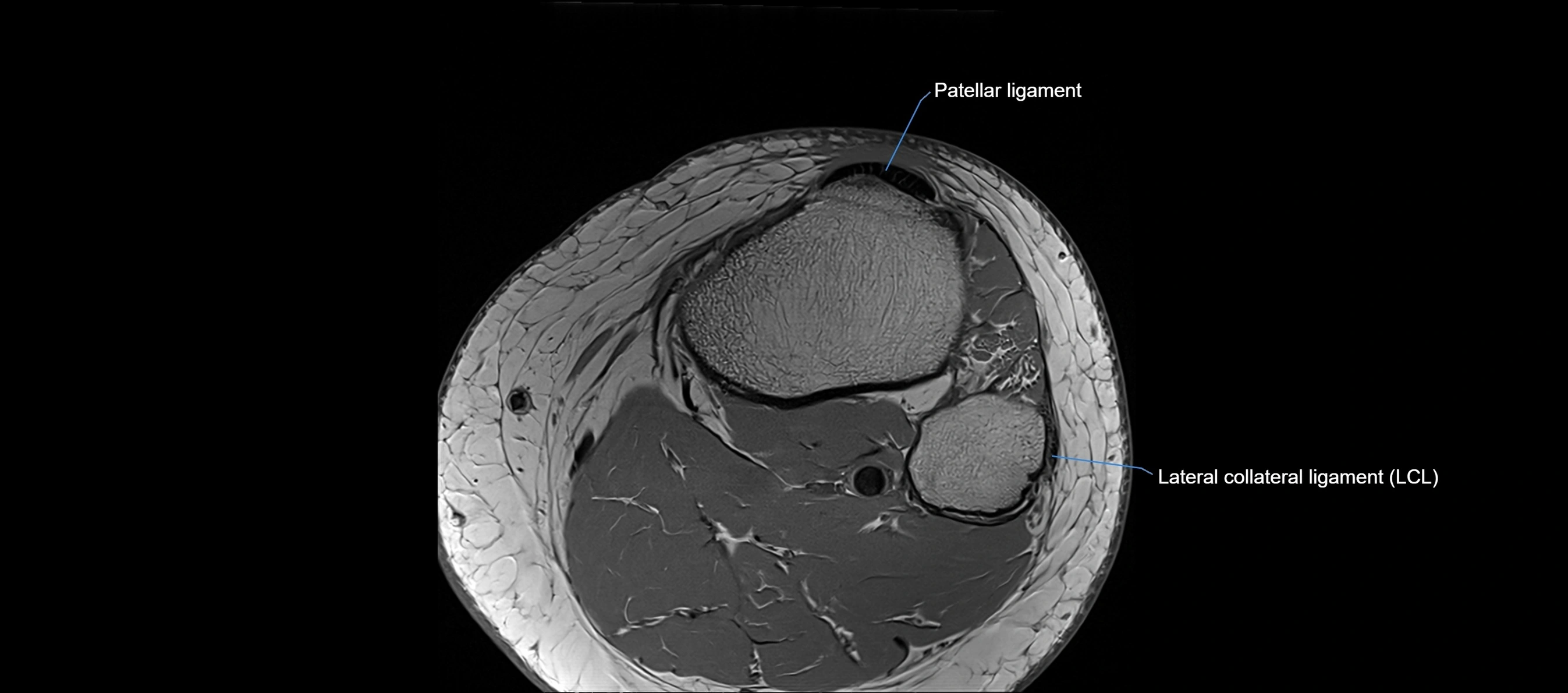 MRI Knee axial  ligaments cross sectional anatomy 3T  radiology  image-img-03001-00044.webp